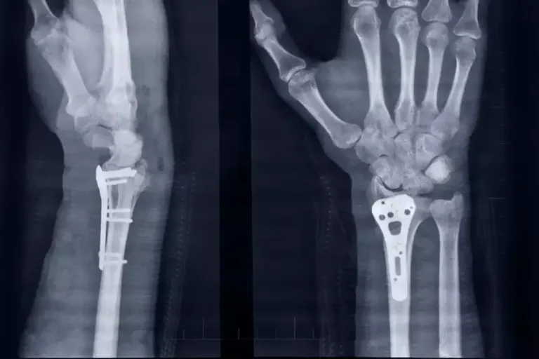 Bone-02