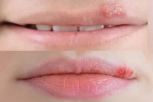 Zou cistus thee kunnen werken bij een koortslip